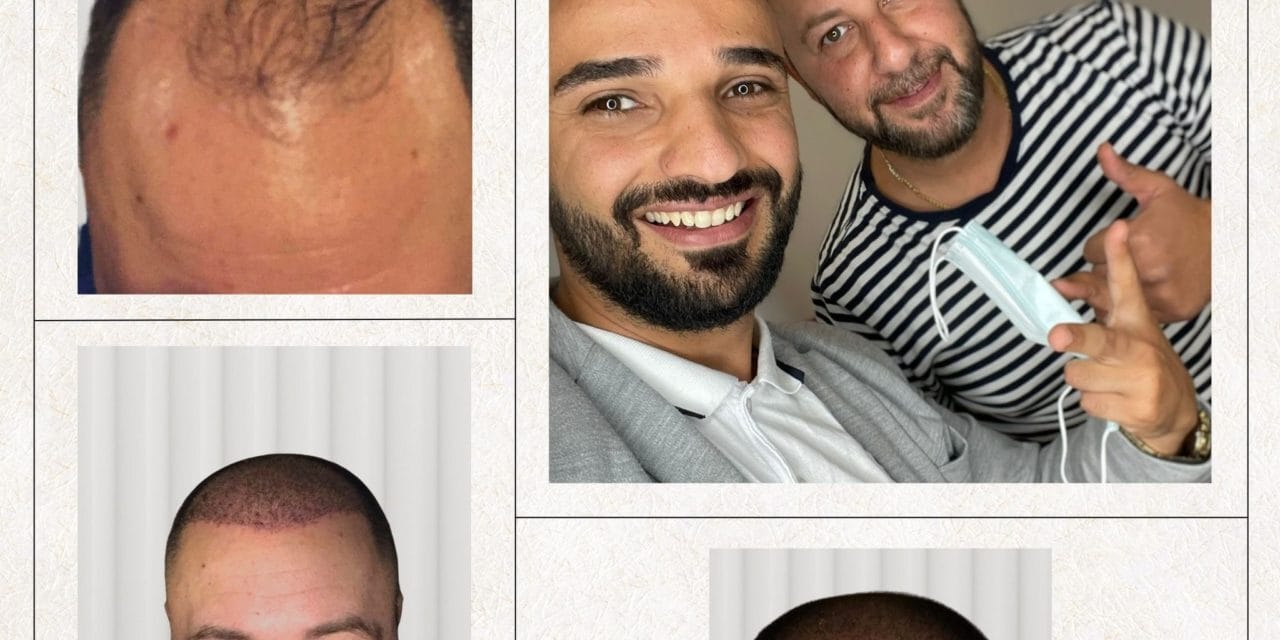 Haartransplantation