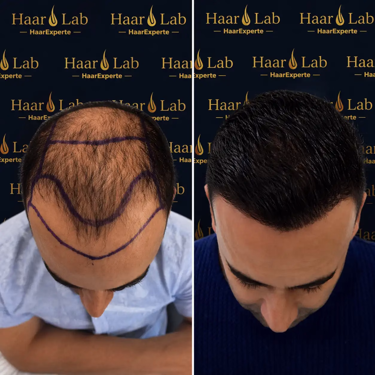 before-after-20260509-140144-62b0cfca https://hairtransplantmannheim.de/wp-content/uploads/2021/10/before-after-20260509-140144-62b0cfca.avif
