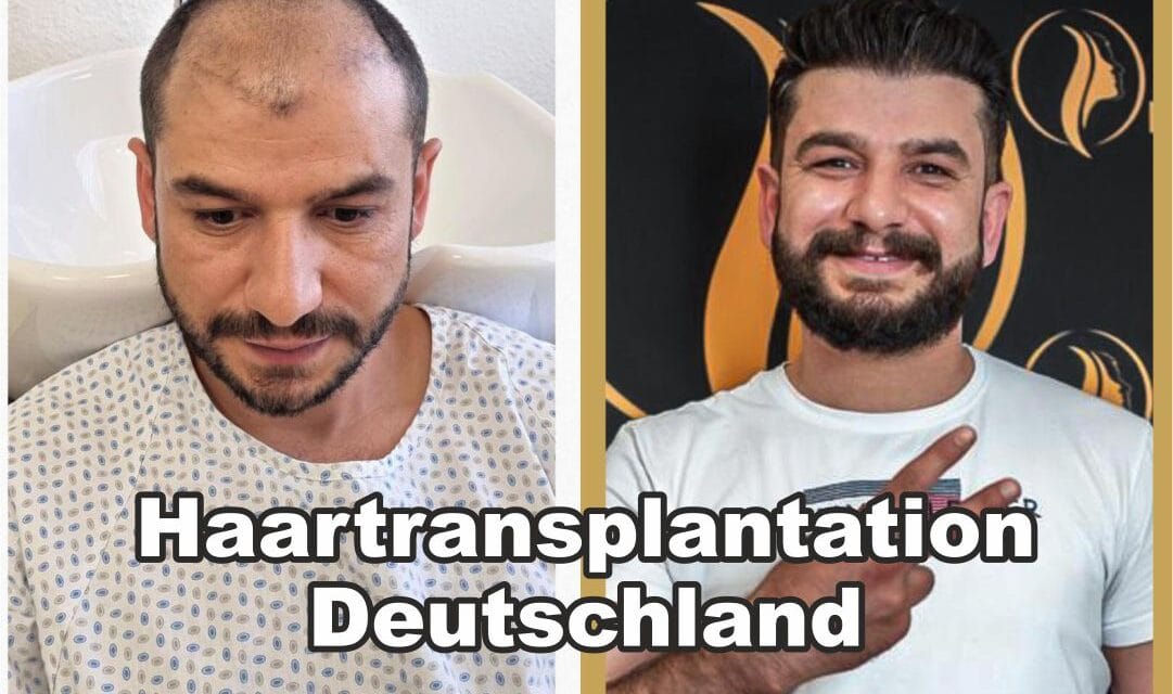Haartransplantation Mannheim – Das sollten Sie wissen, bevor Sie sich entscheiden!