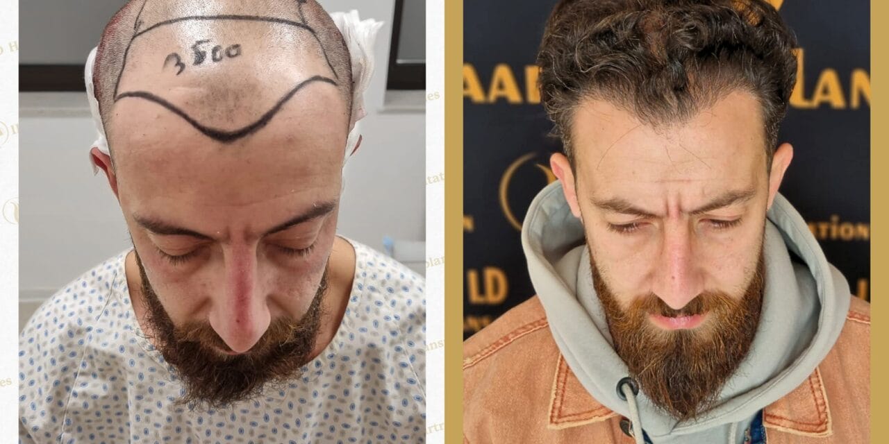 Haartransplantation Mannheim Preise